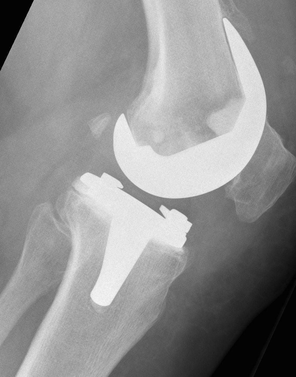 Revision TKR AORI Tibia Type 1 Lateral